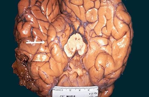 BRAIN HERNIATION S54 (6) Source of picture: WebPath - The Internet