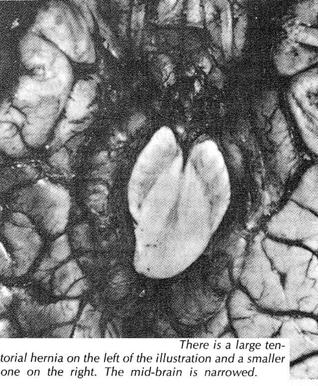 cingulate gyrus) herniate beneath falx compression on internal cerebral veins,