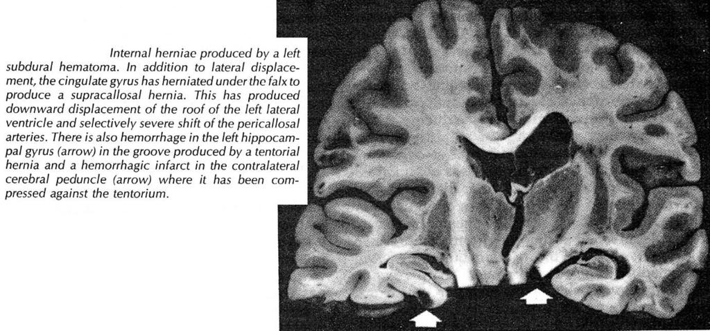 BRAIN HERNIATION S54 (8) INFRATENTORIAL MASSES infratentorial compartment is much smaller than 2 supratentorial compartments - compensatory mechanisms are exhausted much more quickly (tolerated