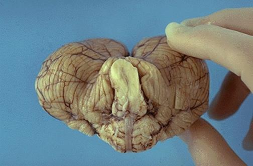 BRAIN HERNIATION S54 (9) Source of picture: WebPath - The Internet Pathology Laboratory for Medical Education (by Edward C.