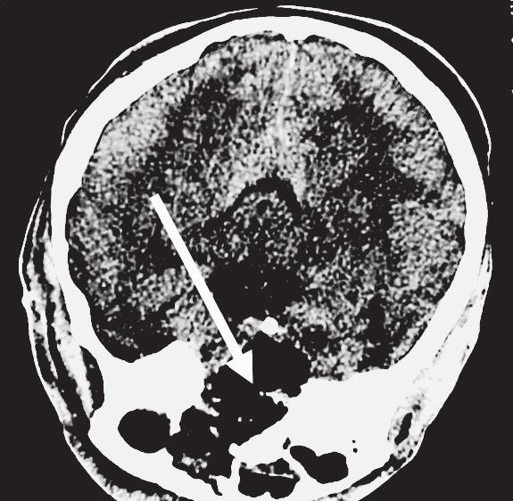 Patient PG, age 27, after a neurosurgical operation necessitated by damage to the brain after a fall from high scaffolding at a construction site.