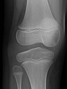 Intra-substance ACL Injuries Reported with increased frequency Skeletally Immature Knee Treatment Dilemma Non-Operative