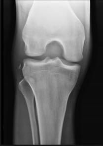 ACL Lateral