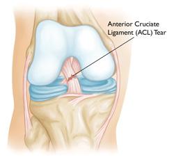 Approximately 50 percent of ACL injuries occur in combination with damage to the meniscus, articular cartilage, or other ligaments.