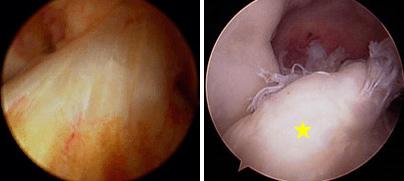 These may be seen on a magnetic resonance imaging (MRI) scan and may indicate injury to the overlying articular cartilage. (Left) Arthroscopic picture of the normal ACL.