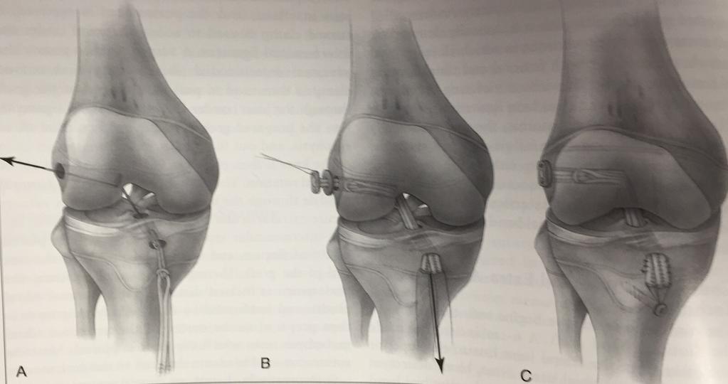 Immature ACL