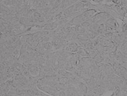 Immunohistochemistry Hemtoxylin & eosin-stined slides of ech mle brest cncer ptient were reviewed; then representtive res of invsive crcinom were mrked, nd their corresponding tissue blocks were