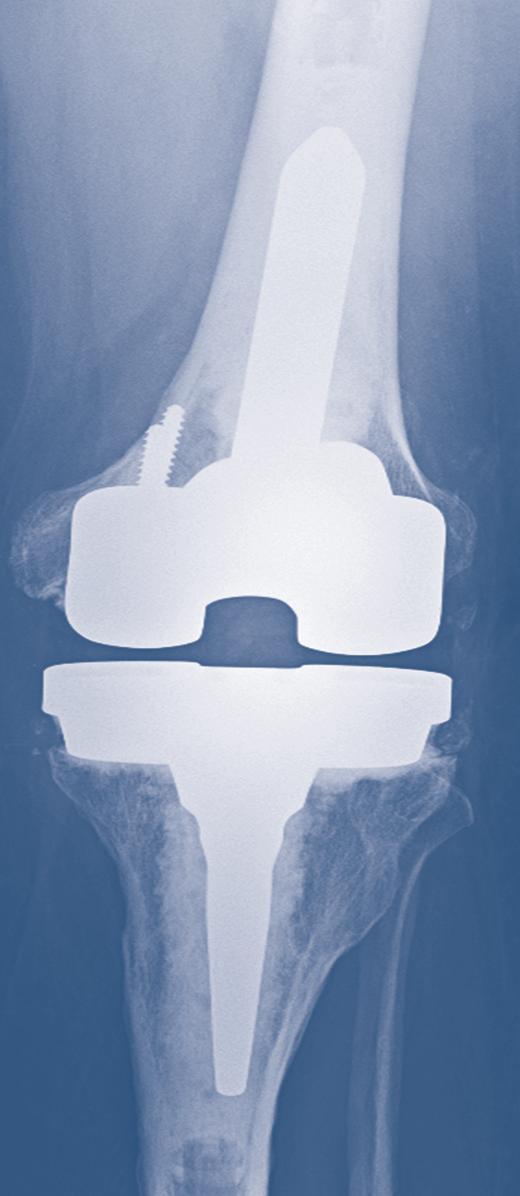 after total knee arthroplasty. Learn how treatment methods have evolved, and familiarize yourself with new equipment and state-ofthe-art techniques during hands-on breakout sessions.