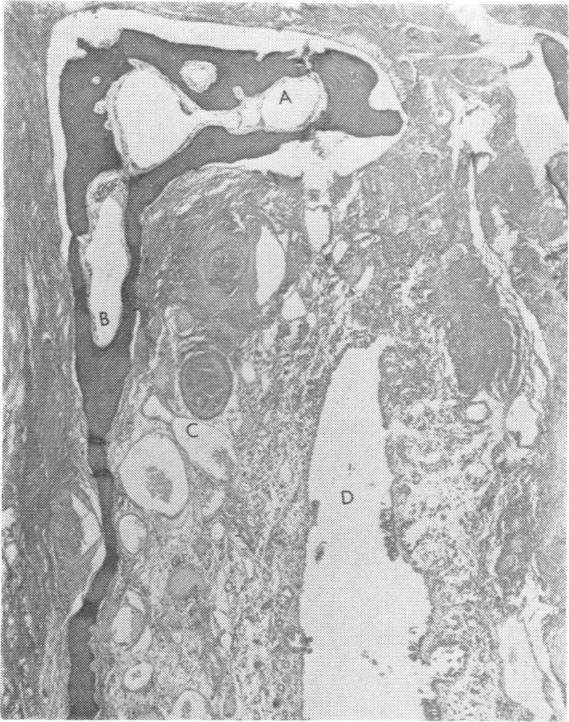 g;i Journal ofneurology, Neurosurgery, and Psychiatry, 1979, 42, 983-987 Olfactory mucosa in herpes simplex encephalitis J. A.