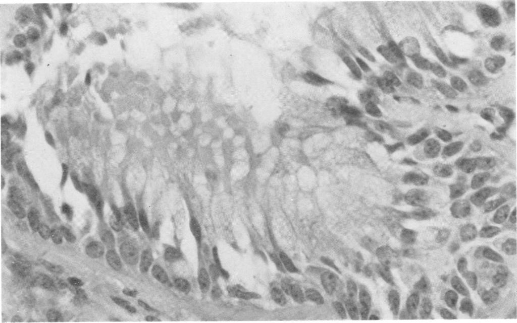 s.,. : Olfactory mucosa in herpes simplex encephalitis 11 #S fc:.: 2..>. ti v:.t.el: ::.. ~~~~~ T i ~~~~~~~~~~~~~~~~0,< XAftK Fig. 3 Section of olfactory epithelium (case 1).