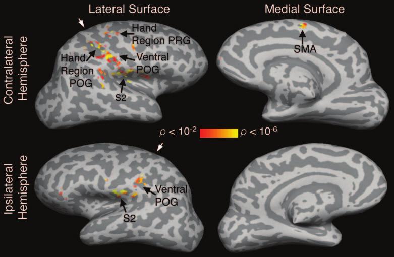 Structural plasticity in stroke patients Brain (2006), 129, 2722 2733 2727 Fig.