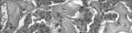 Pancreatic Endocrine Neoplasms Usually occur in body/tail Hypervascular,