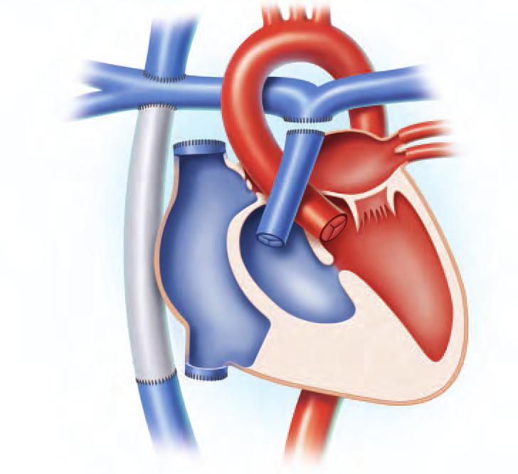 GORE-TEX Vascular Graft Pulmonary Artery GORE-TEX Vascular Graft Inferior Vena Cava Depiction of an Extracardiac Fontan procedure.