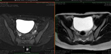 Figure IIA: axial section of MRI of normal female pelvis showing presence of bilateral ovaries (white arrows).