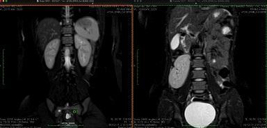 . Figure IIIA: Coronal section of MRI of normal abdomen showing presence of both kidneys at normal location.