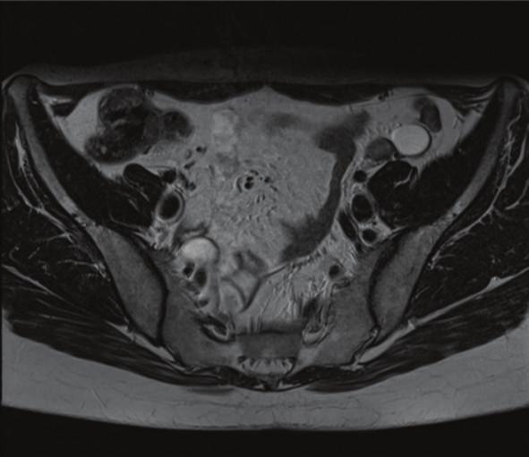 2 Case Reports in Radiology (a) (b) (c) Figure 1: A 34-year-old female with CAIS syndrome.