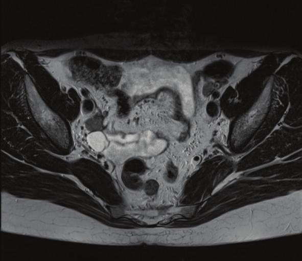 Sagittal image (c) shows absence of Müllerian structures and presence of the lower vagina (yellow arrowheads) (3T magnetic resonance imaging.