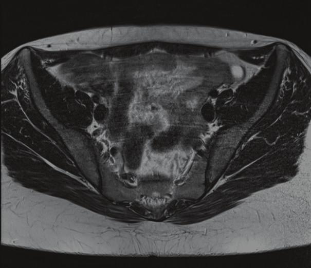 Sagittal image (c) showing absence of the Müllerian structures and the presence of the lower vagina (yellow arrowheads). (3T Magnetic Resonance Imaging.