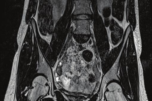 4 Case Reports in Radiology (a) (b) (c) (d) Figure 4: 38-year-old girl/female affected by CAIS.