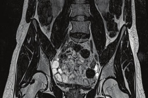 Sagittal T2 weighted image (d) showing agenesis of the Müllerian structures and presence of the lower third of the vagina (yellow arrowheads). (3T Magnetic Resonance Imaging.