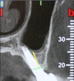 Fig. 2 a,b,c: Postoperative cross-sectional CT scans showing supporting bone around the