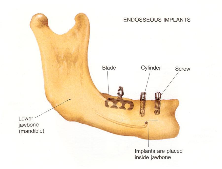 based on the concept of osseointegration. The concept was originally introduced by a Swedish research team headed by Per Ingvar Branemark in 1952.