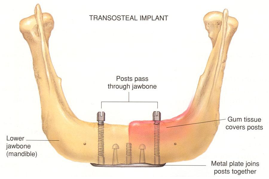 Transosseous implants are designed mainly for use in the mandible and are surgically inserted into the jaw bone; however, they penetrate through the entire jaw so that they emerge opposite the entry