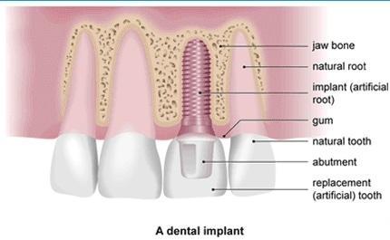 Assessing a Patient for Implants Before the placing an implant, a considerable amount of surgery time is used to undertake a preoperative and pre-treatment plan with the patient.
