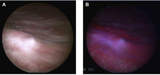 Photodynamic diagnostic cystoscopy (Fluorescence)( HAL) Richards et al J Urol 2014 PDD cystoscopy metaanalysis Prospective pooled data :1345 patients PDD detected significantly more tumours than WL