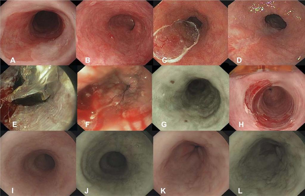 January 2010 ABLATION OF NEOPLASTIC BARRETT S ESOPHAGUS 27 Figure 2. Endoscopic images of circumferential RFA, complicated by nontransmural mucosal laceration. (A) C11M12 BE.