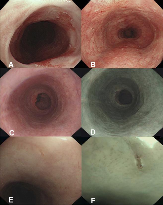 28 POUW ET AL CLINICAL GASTROENTEROLOGY AND HEPATOLOGY Vol. 8, No. 1 Figure 3. Endoscopic images of a small island of glandular mucosa detected during the follow-up evaluation.