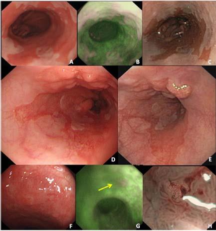 targeted detection of dysplastic lesions (low-grade intraepithelial neoplasia, high-grade intraepithelial neoplasia, or carcinoma) with HD-WLE detecting dysplasia in 23 patients as compared to 21