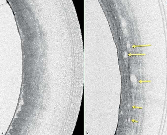 E320 Fig. 2 a VLE image showing loss of layered architecture in the setting of no surface pits and crypts. b Atypical glands (yellow arrows) with loss of layered architecture.