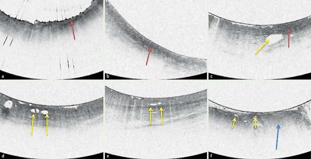 E321 Fig. 3 Volumetric laser endomicroscopy images corresponding to the sites that allowed for targeted biopsies. Patient 1 corresponds to A, Patient 2 to B, etc.