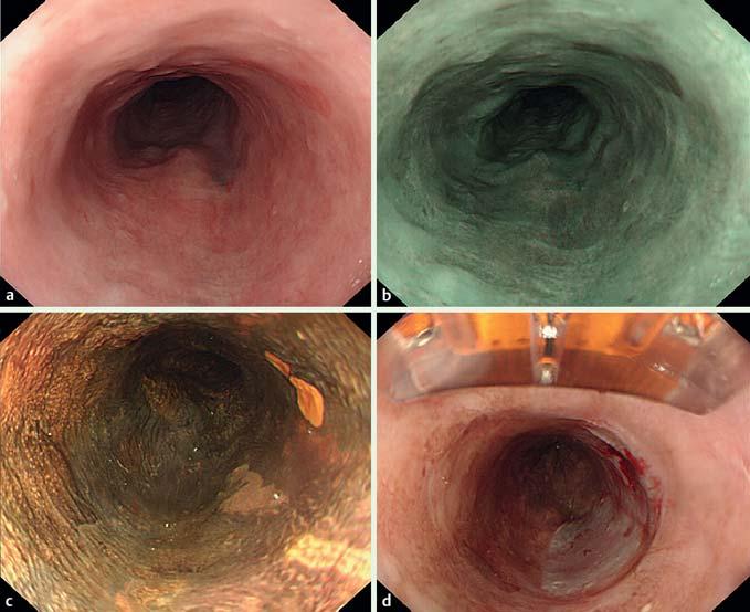 Fig. 2 Secondary focal radiofrequency ablation of small residual unstained lesions.