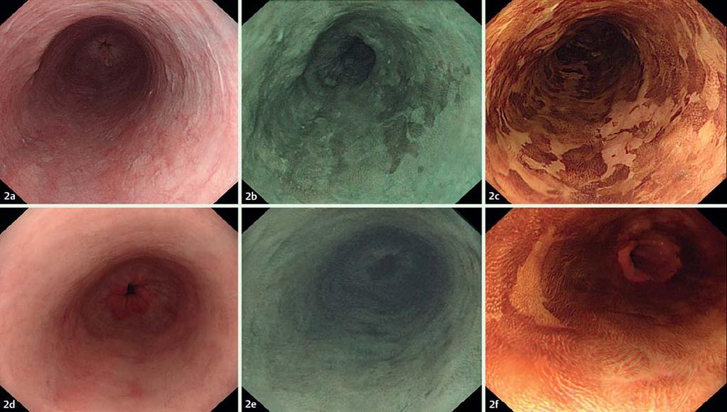 Fig. 3 Three cases of early esophageal squamous cell neoplasia before and after radiofrequency ablation treatment, as seen with white light endoscopy, narrow-band imaging, and Lugol s chromoscopy.