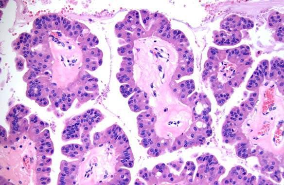 ) IOPN (Intraductal oncocytic papillary