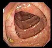 Ulcerative colitis Colon