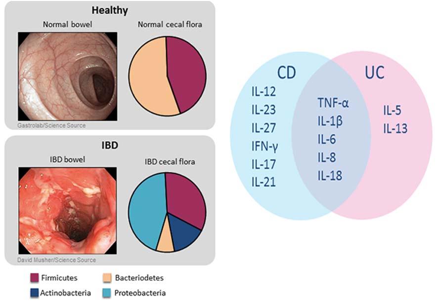 Differences in Microbiome associated with IBD Types of bacteria associated with UC/CD different than non-ibd Production of proinflammatory cytokines Distinct in UC vs CD Forbes JD et al.