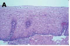 6 Normal epithelium Mild dysplasia Moderate dysplasia A B C Severe dysplasia Carcinoma in situ