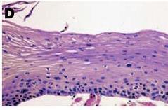 Progression of (a) normal squamous epithelium to (b) mild dysplasia, (c) moderate dysplasia, (d)