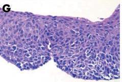high-grade dysplasia, and finally to EAC, as shown in Figure 2 [10, 11].