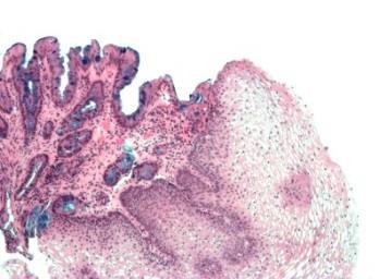 7 with low-grade dysplasia with high-grade dysplasia Esophageal adenocarcinoma A B C D Figure 2.