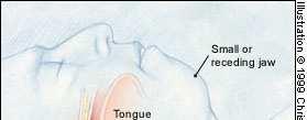The tongue is normal in size and is angled forward.