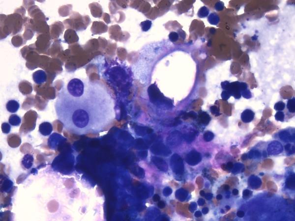 Bone marrow aspirate Megakaryocyte atypia: (approaching