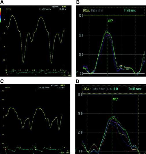 LVEF/Systolic function Typically normal But may be borderline or mildly reduced (50-55%) leading to concern about dilated cardiomyopathy Role for stress echocardiography in establishing contractile