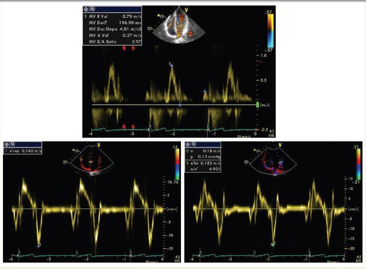 Galderisi et al European Heart Journal Cardiovascular Imaging (2015) 16, 353 Diastolic Function in HCM Decreased