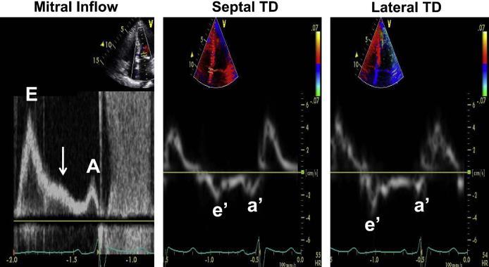 When left atrial pressure is elevated Journal of the American Society of Echocardiography 2011 24, 473-498DOI: Aorta Pathologic