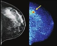 risk of breast cancer.