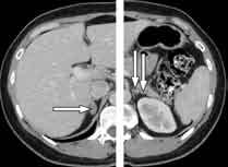 Primary Aldosteronism The Role of Adrenal Venous Sampling The Challenge The triad of hypertension, hypokalemia, and an aldosterone-producing adenoma (APA) of the adrenal gland was first reported by